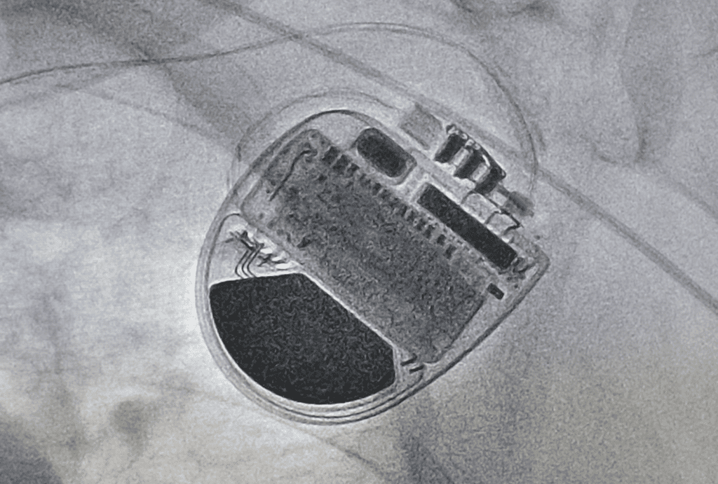 a permanent pacemaker inside the body of a patient